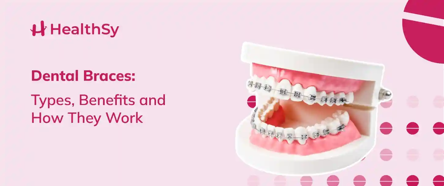 dental-braces-types-benefits-and-how-they-work