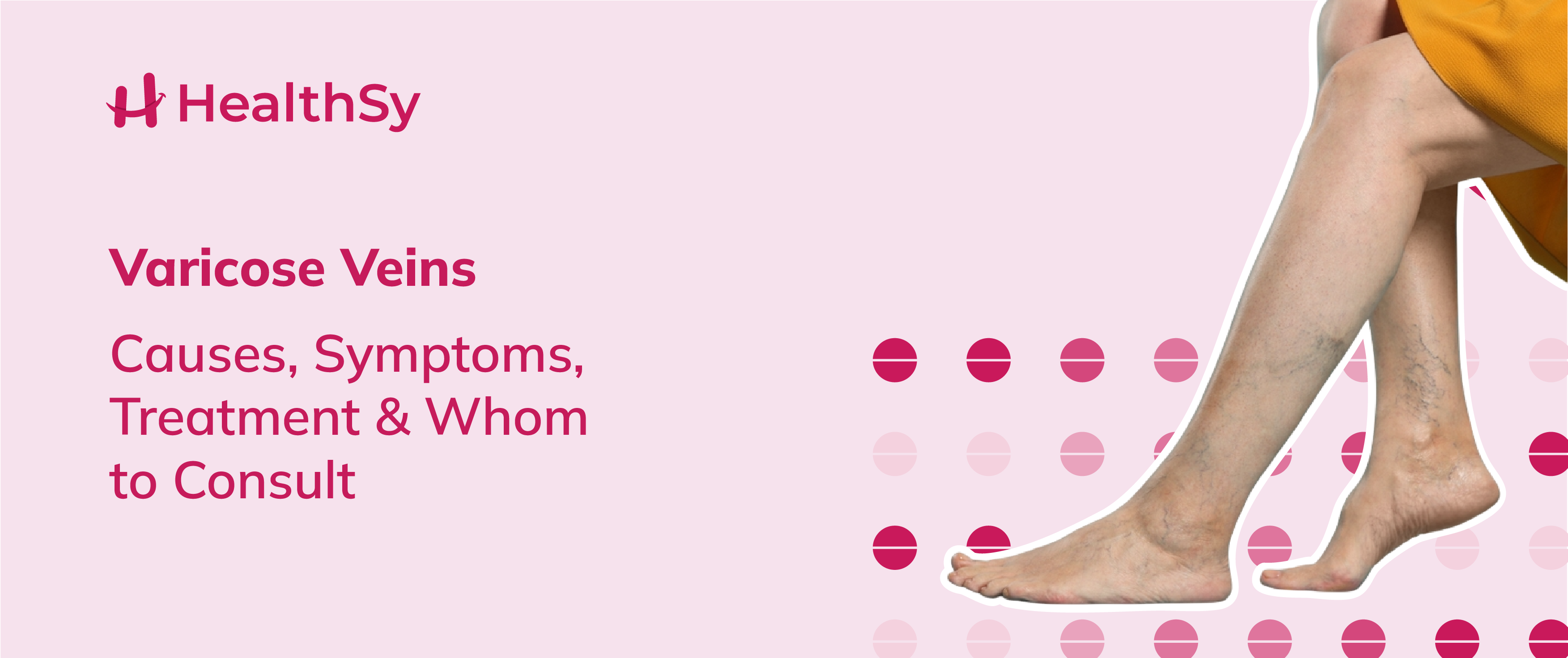 Varicose Veins - Causes, Symptoms, Treatment & Whom to Consult