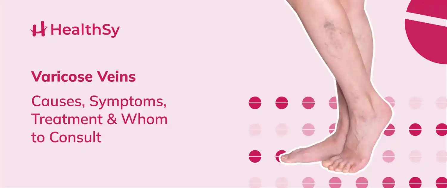 Varicose Veins - Causes, Symptoms, Treatment & Whom to Consult