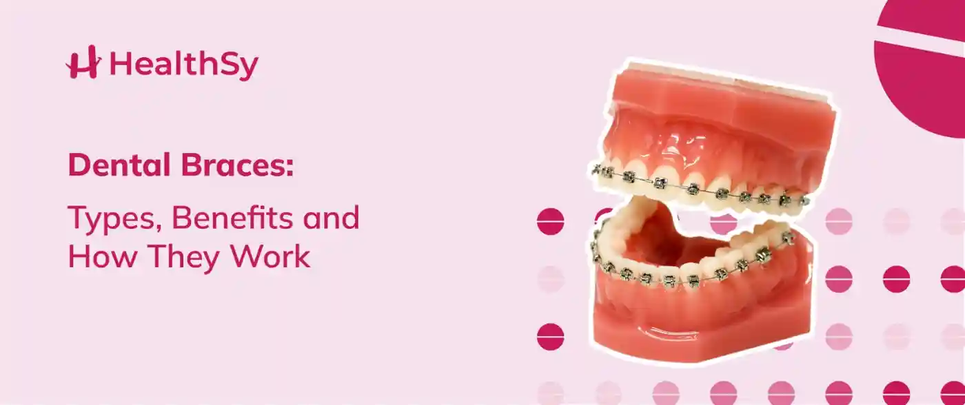 dental-braces-types-benefits-and-how-they-work